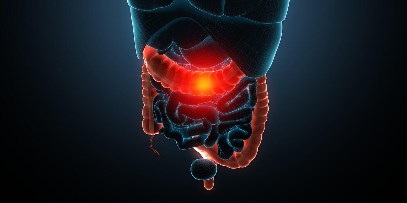 Neue Studie bestätigt Wirkung von CBD bei Morbus Crohn