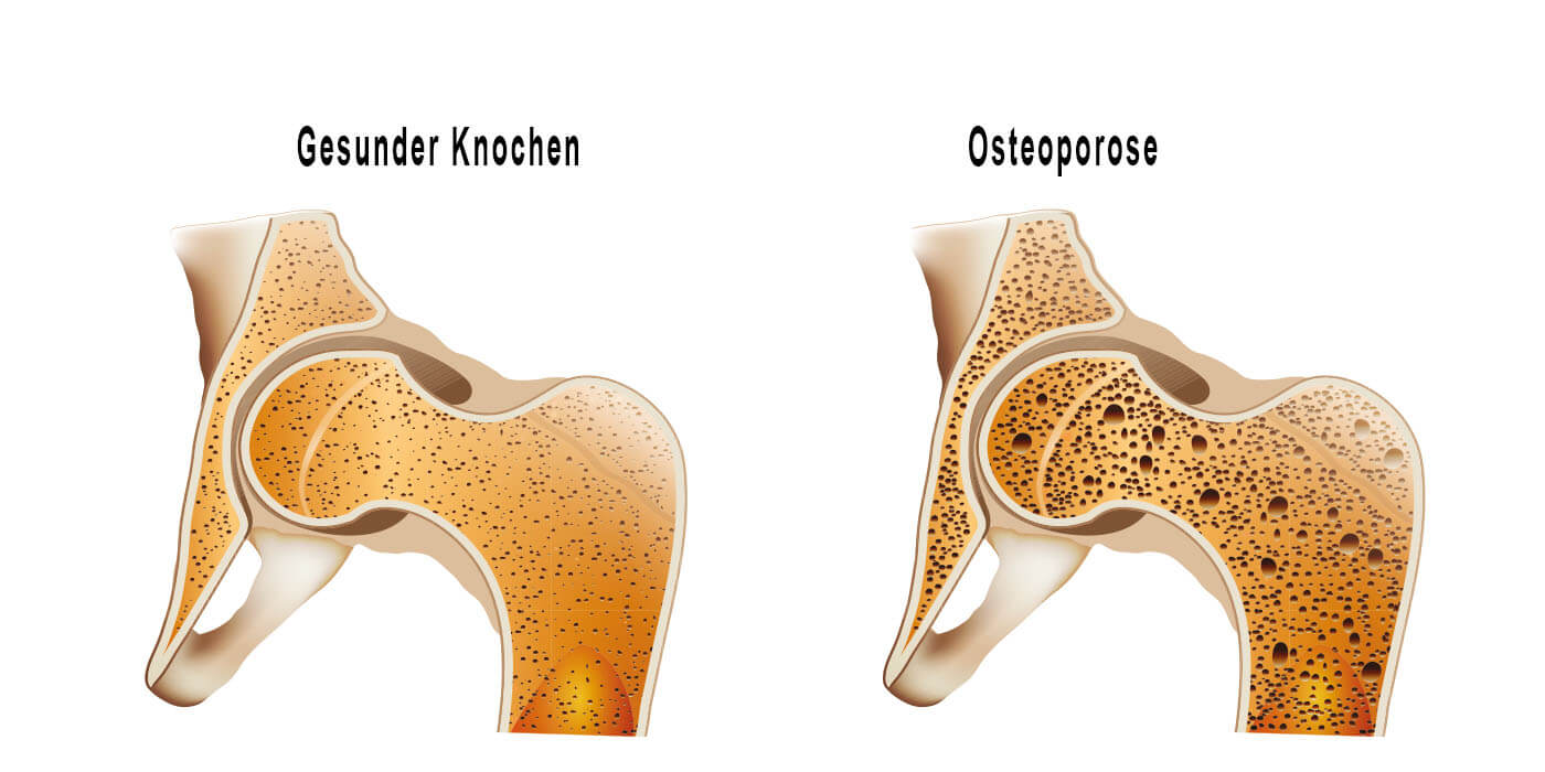 Die Wirkung von CBD bei Osteoporose
