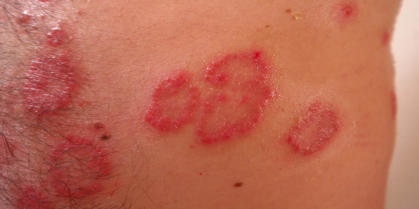 ausschlag von vape Meine E-Zigarette hat meine Haut ruiniert main image 1